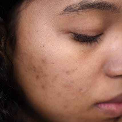 Prakriti Sattva Ayurvedic remedies for teenage acne